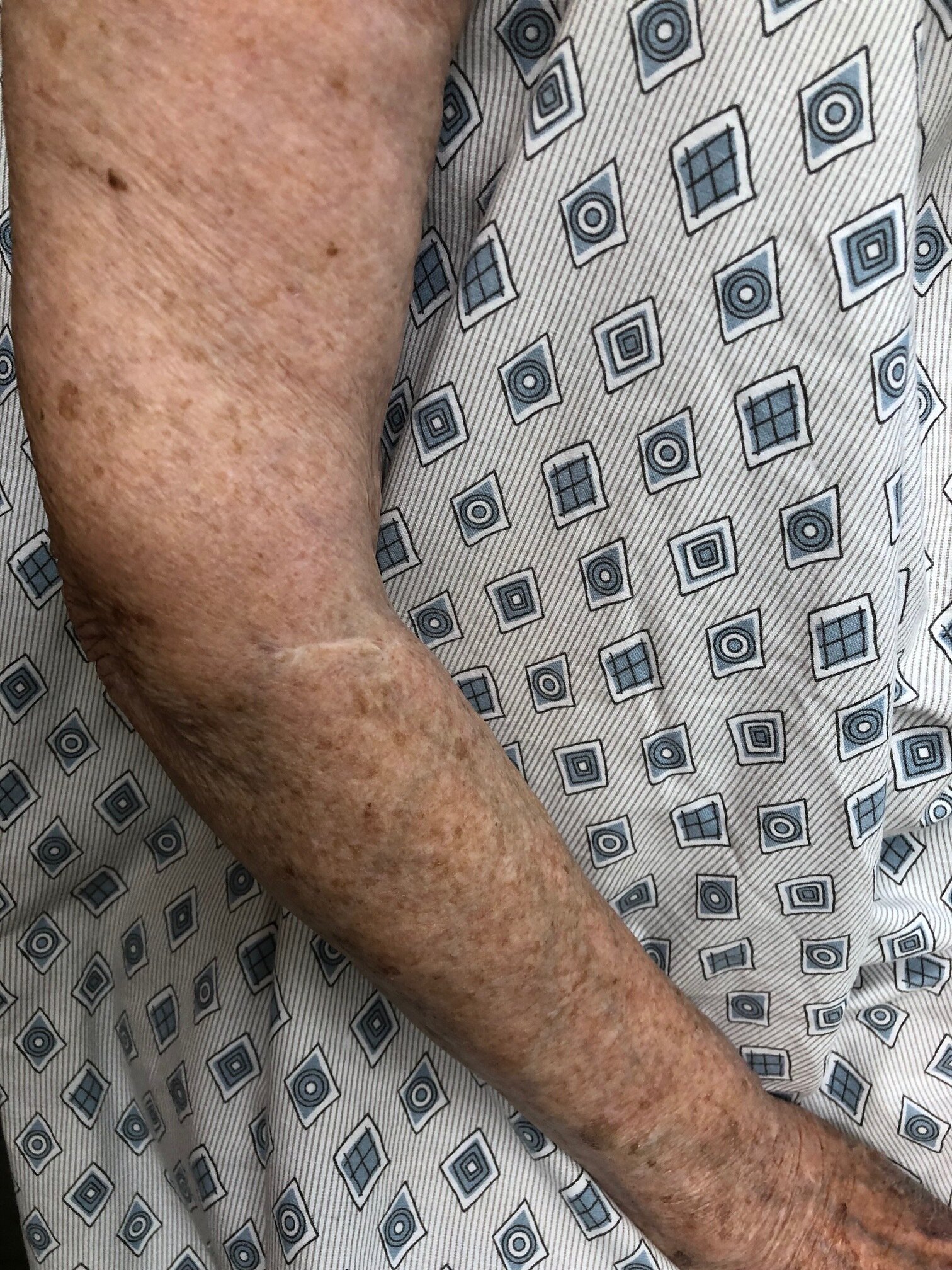 Surgical scar on sun damaged skin