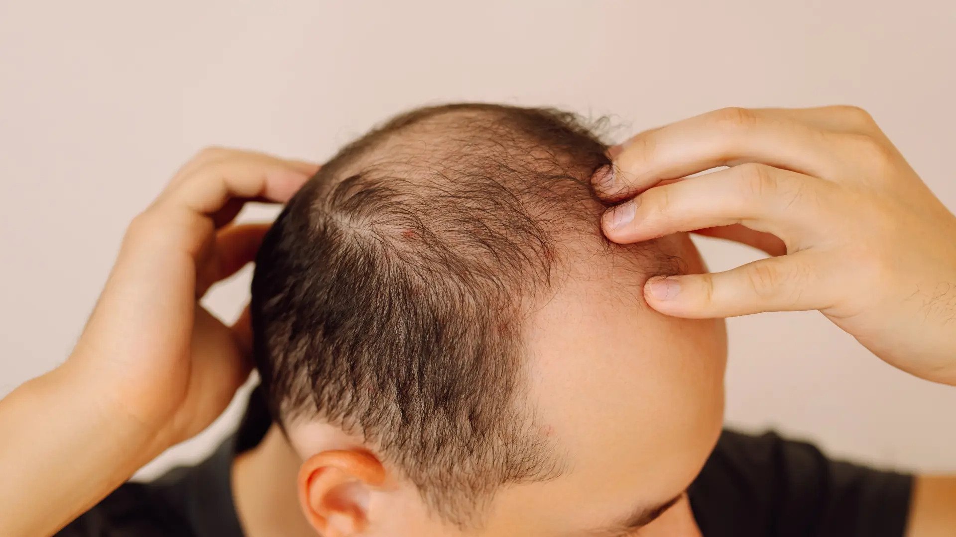 ¿Tienes algo de cabello? Por qué actuar a tiempo mejora tus resultados