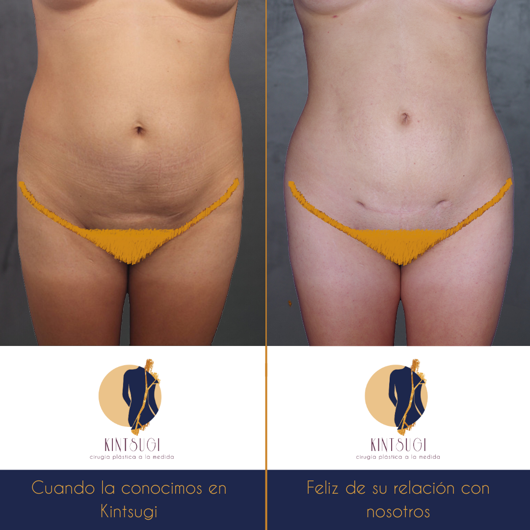 Plastic surgery Guatemala, before and after photos, liposuction