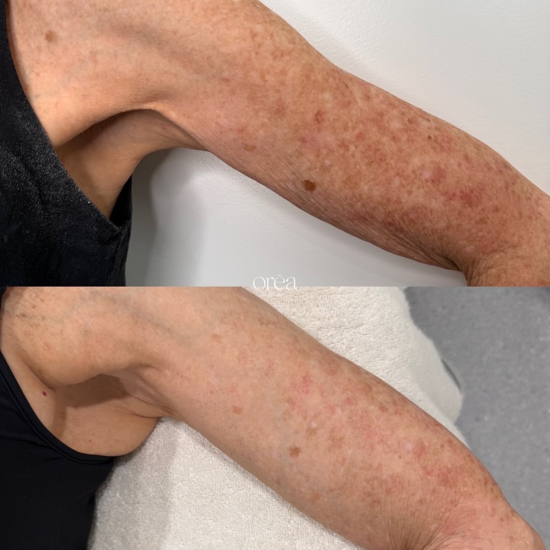Did you know we can treat the body as well? 

This result was achieved after 1x Lumecca IPL on the arms. Lumecca is comfortable, has minimal downtime and is suitable for those with unwanted pigmentation, redness or vascular concerns.

oreaaesthetics.