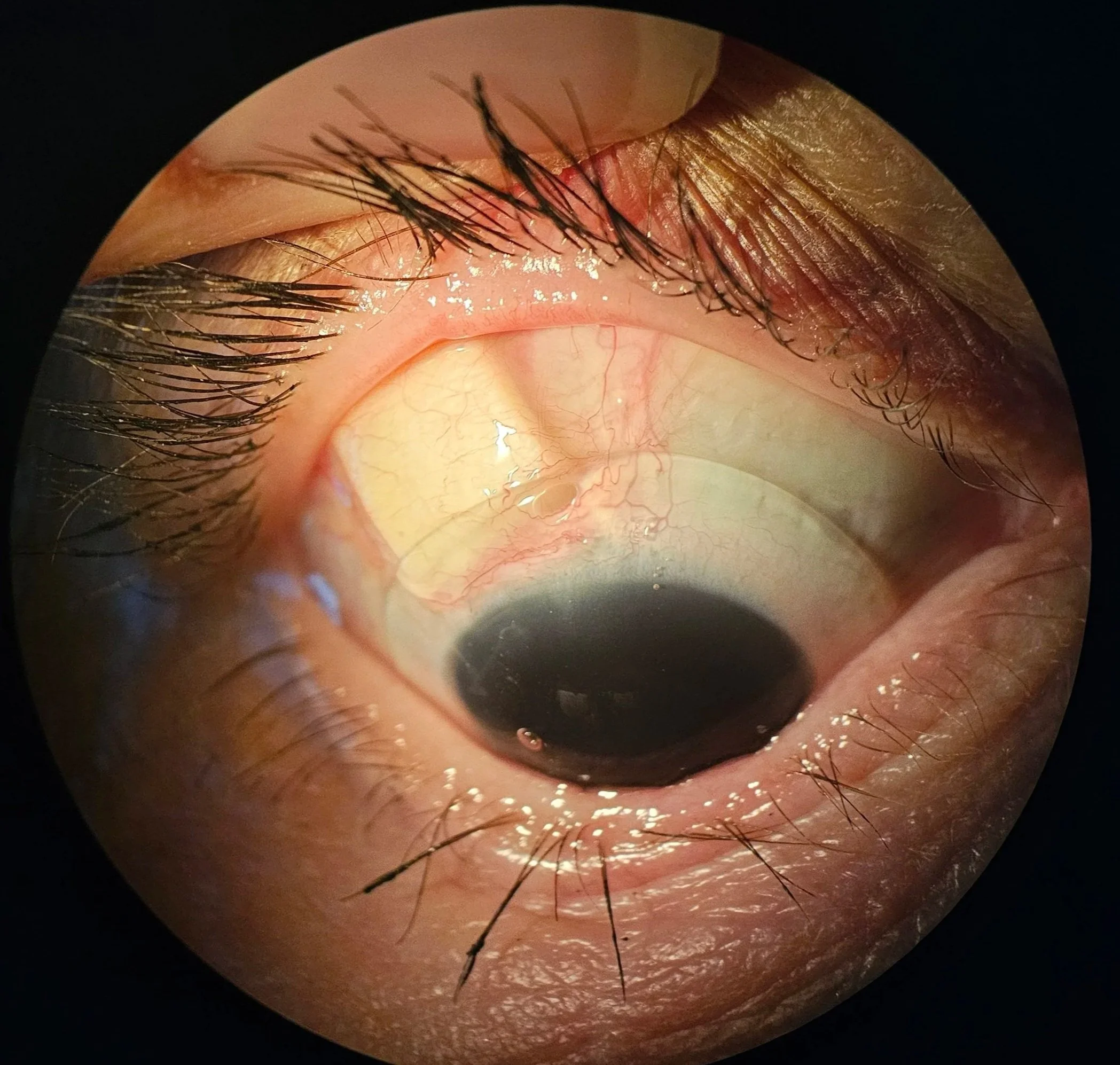 Close-up view of an eye with a glaucoma tube, with an Eyeprint scleral contact lens on, showcasing how Eyeprint lenses can fit very irregular eyes.