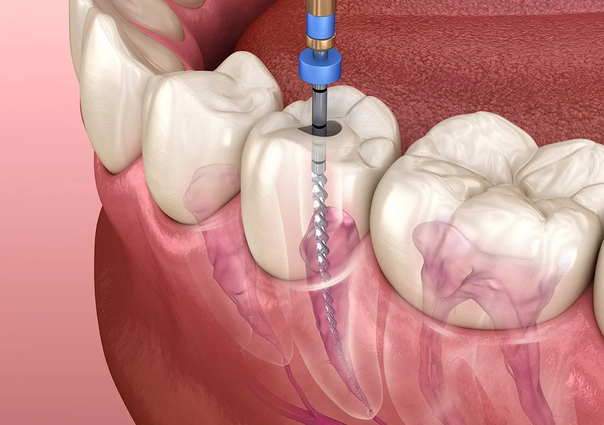Root canal