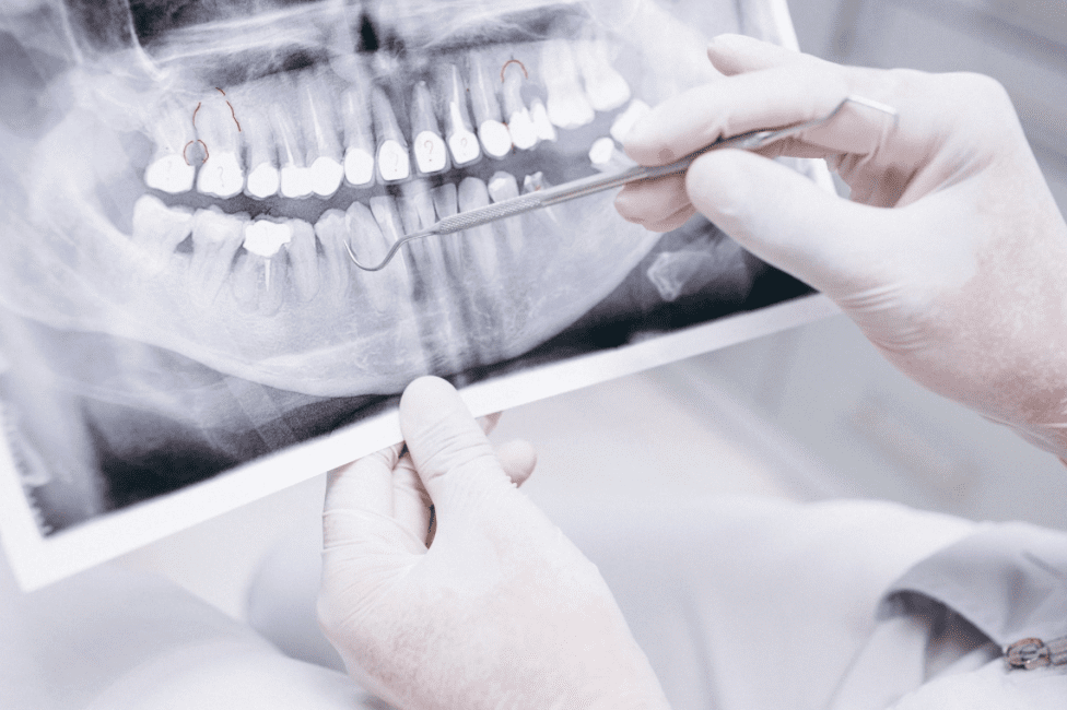 Xrays