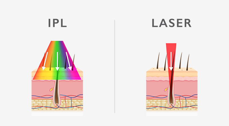 Laser Hair Removal vs IPL
