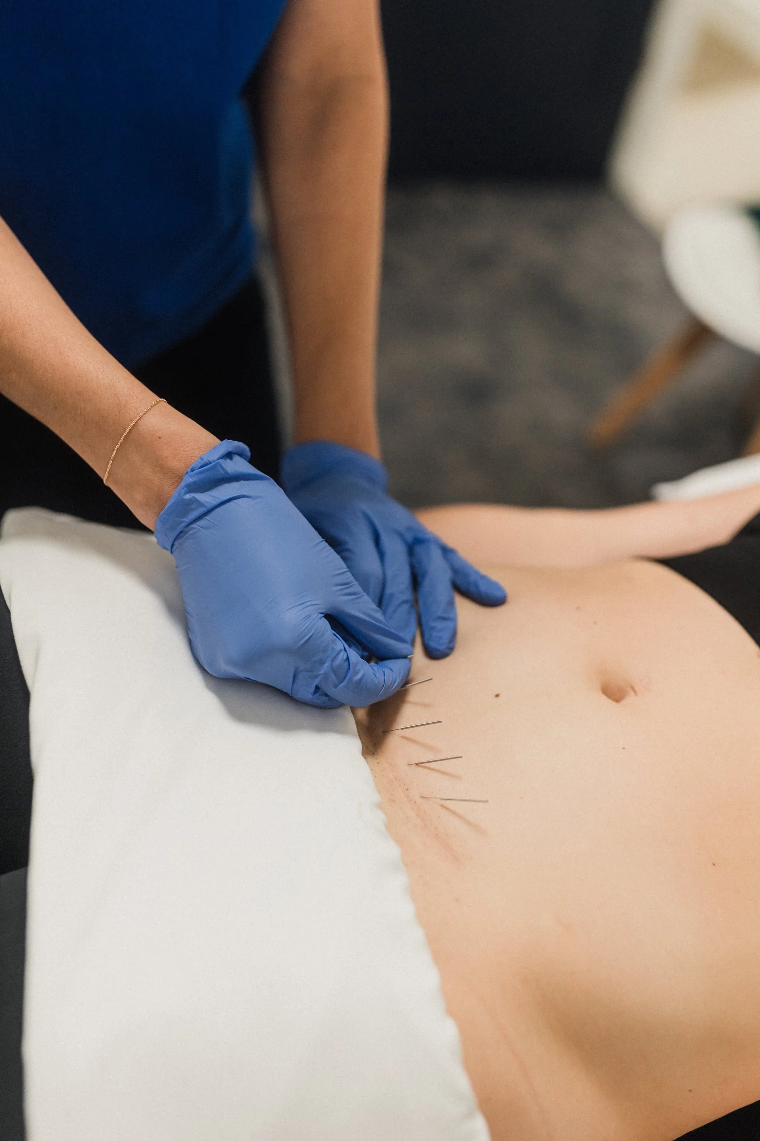 dry needling in abdomen