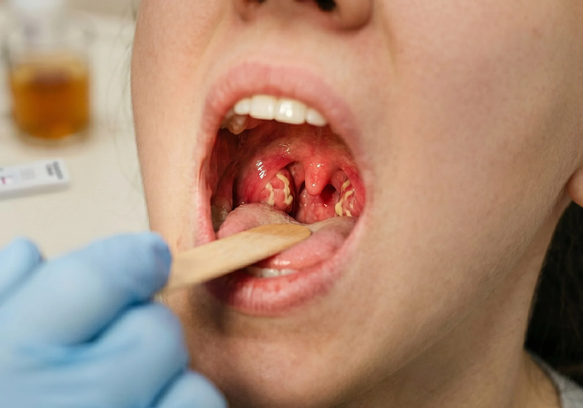 Strep Throat: Symptoms, Home Testing, and Professional Care