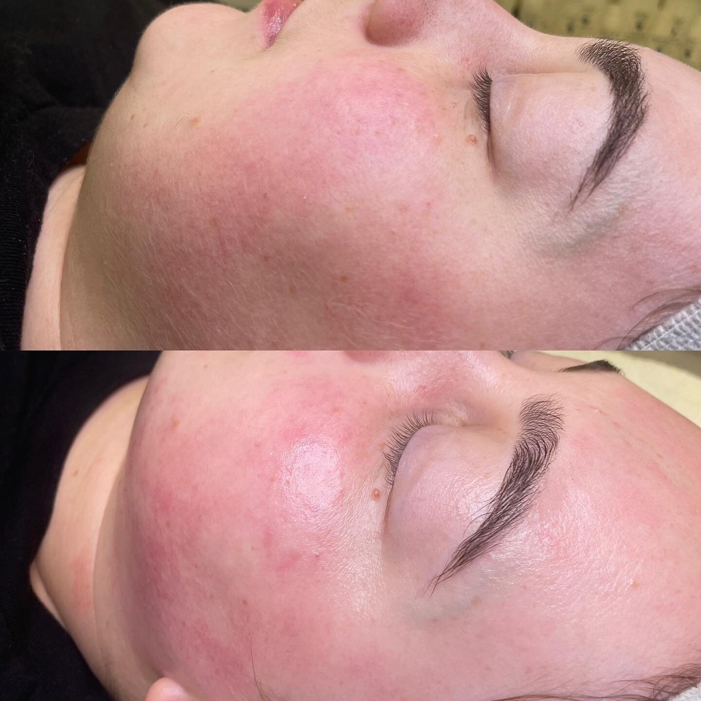 Instant Glow! 

Refresh your skin with Dermaplaning &amp; LED therapy. 
Dermaplaning will remove dead skin cells, peach fuzz, and will ensure a even makeup application. You will have instant bright, glowy skin! 

Booking link is in our bio ✨
&bull;
&