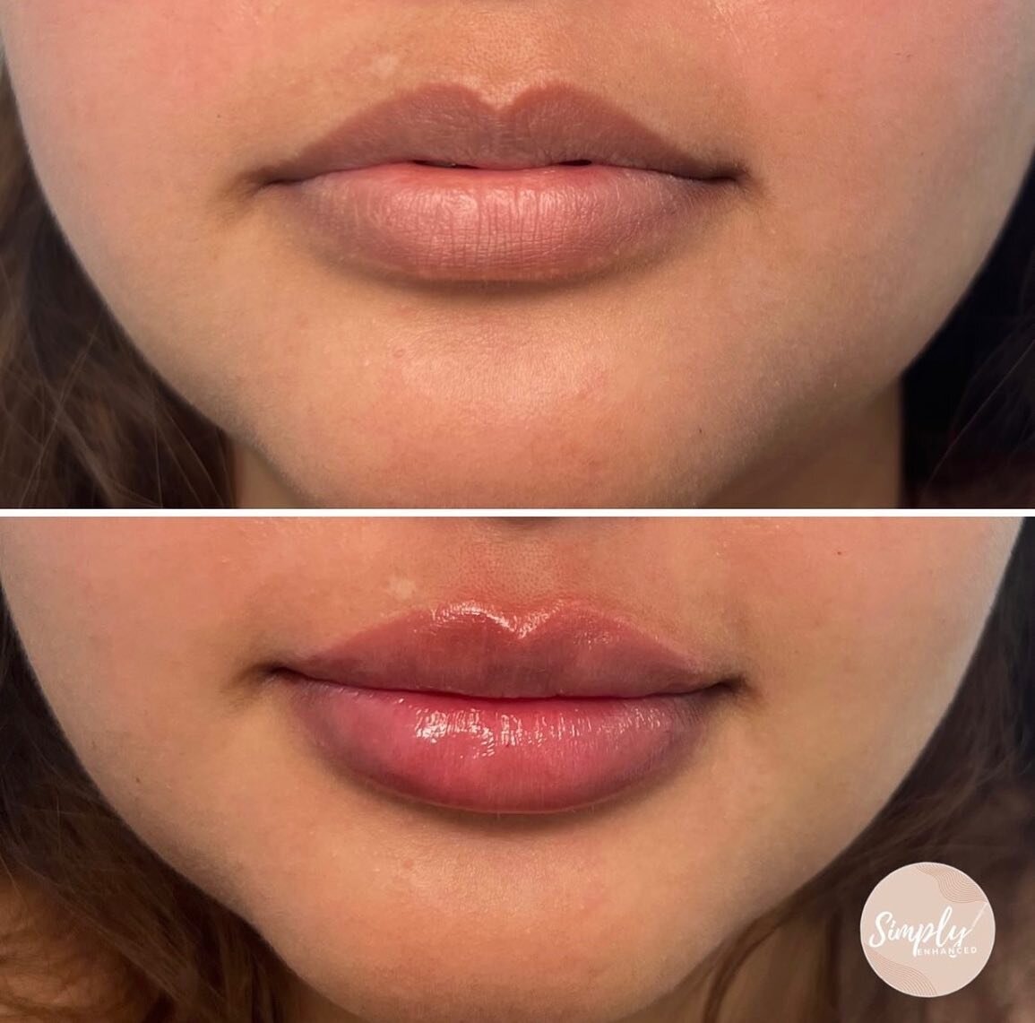 Kelly working her magic 💉

Simply enhancing her clients natural lips 👄 

For the month of May, receive $25 off your treatment with Kelly! 
Visit her IG to book ✨
@simply.enhanced 
&bull;
&bull;
&bull;
&bull;
#lipfillermelbourne #melbournecosmeticnu