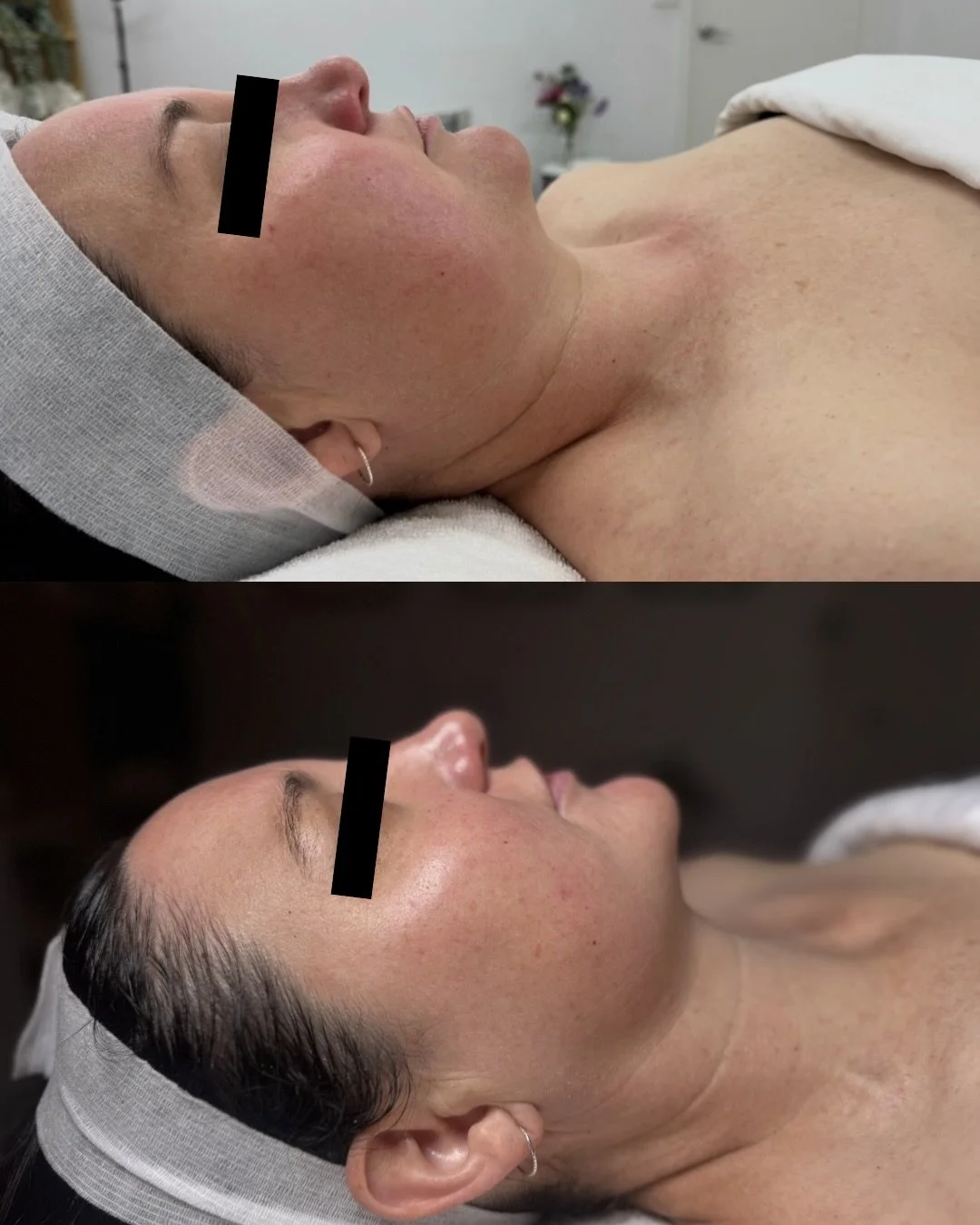 ✨ Skin health &amp; age management results ✨

This beautiful progress is the result of skin needling, targeted facials, and consistent prescribed home care working together to support long-term skin health.

Our focus was on stimulating collagen, imp