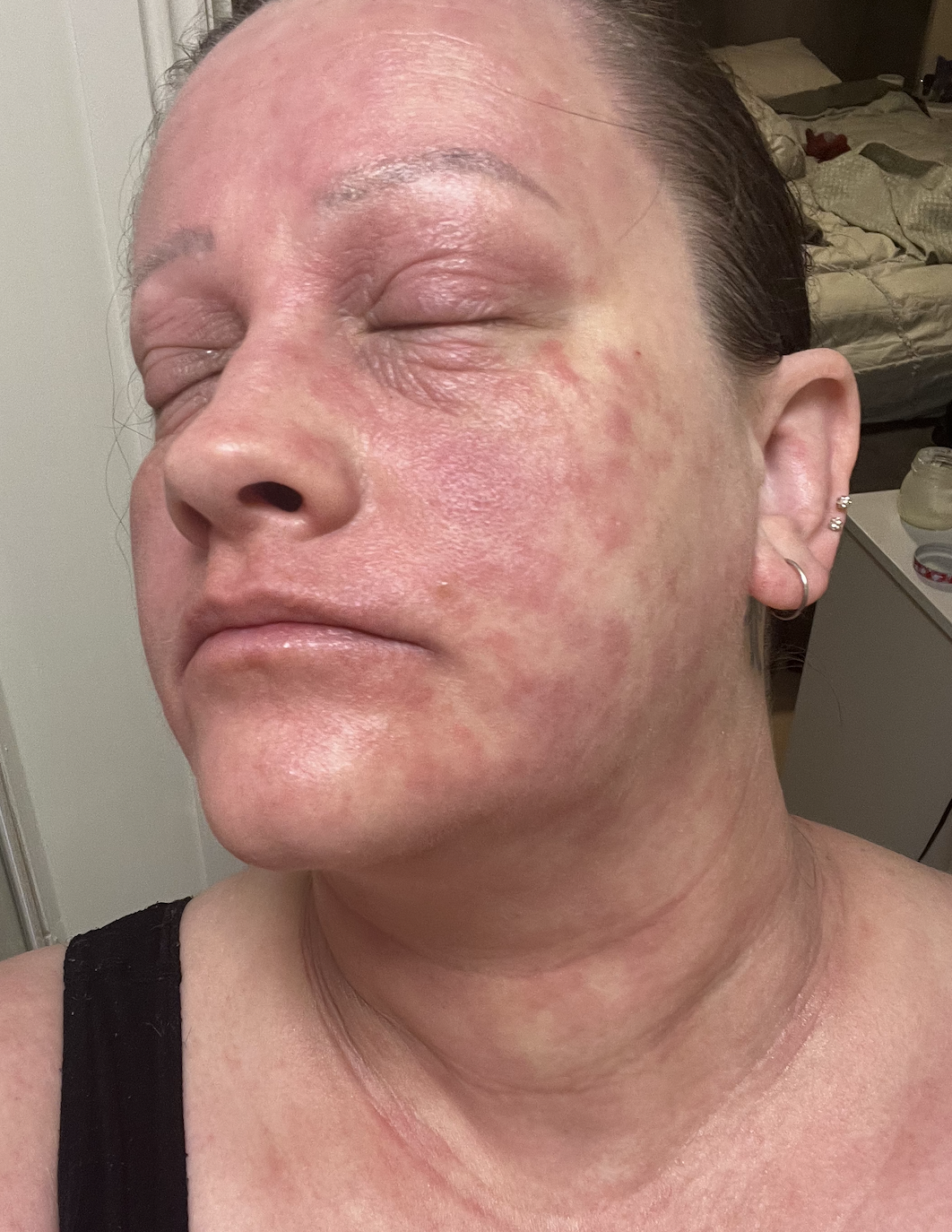 Julie's Story: Rebuilding a Compromised Skin Barrier, Inside and Out