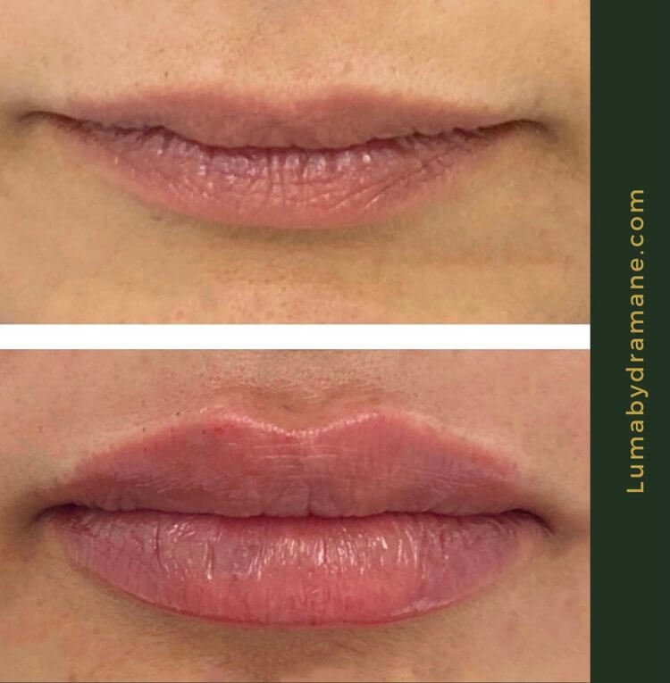 natural lip fillers calgary