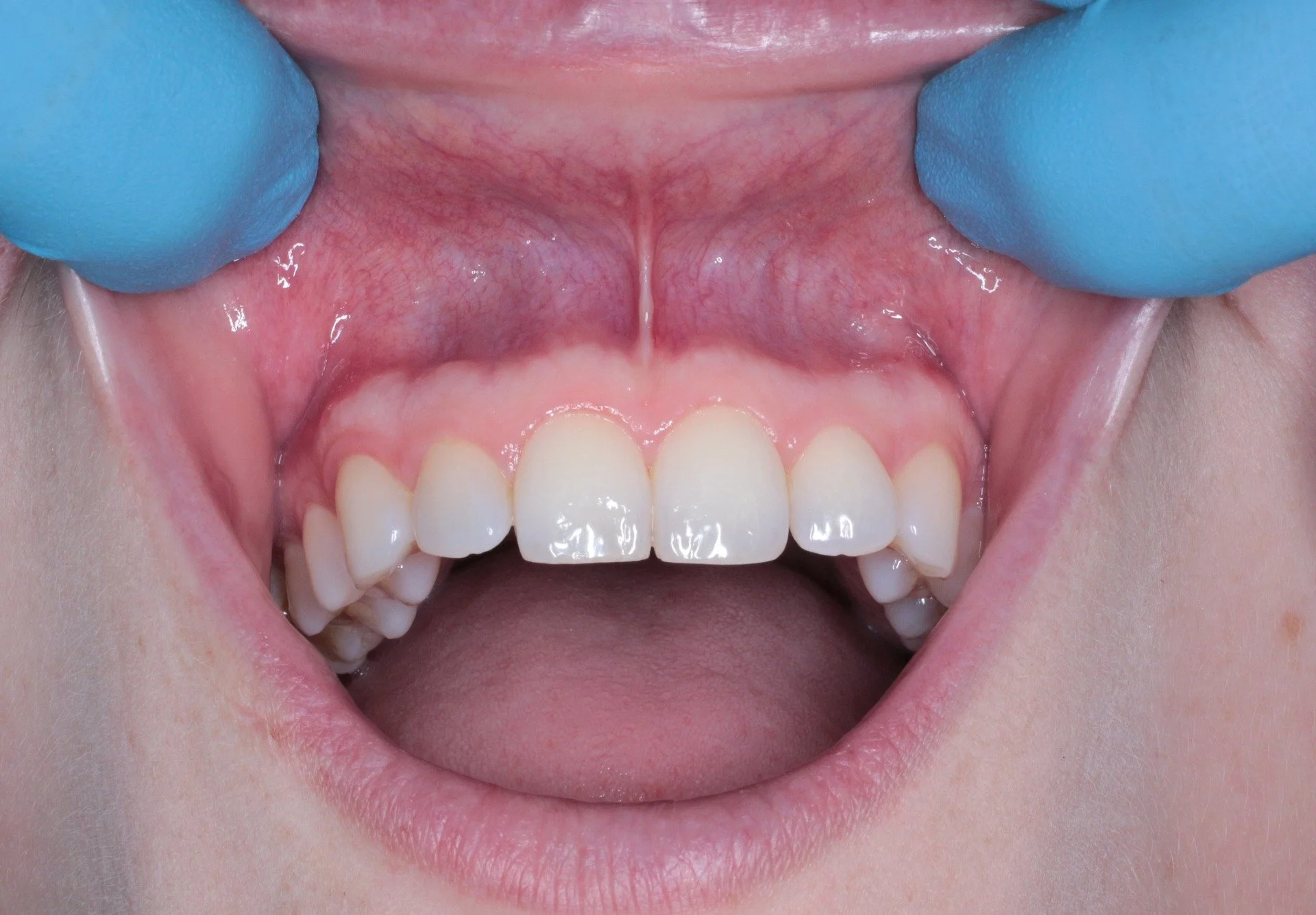 A person's teeth show with a clinician doing an oral health exam.