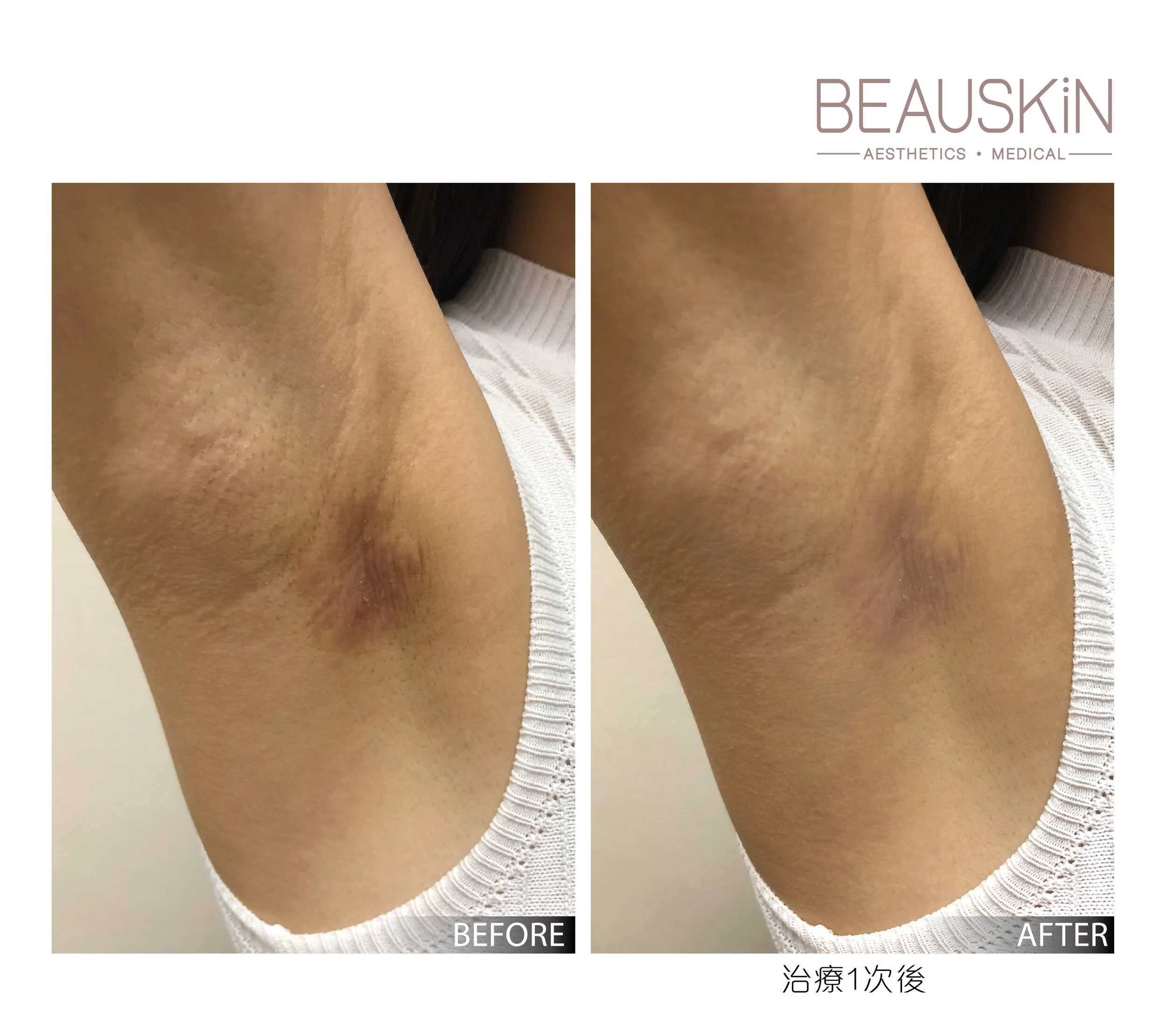 腋下 腋下美白療程FOTONA QX MAX — BEAUSKIN Medical