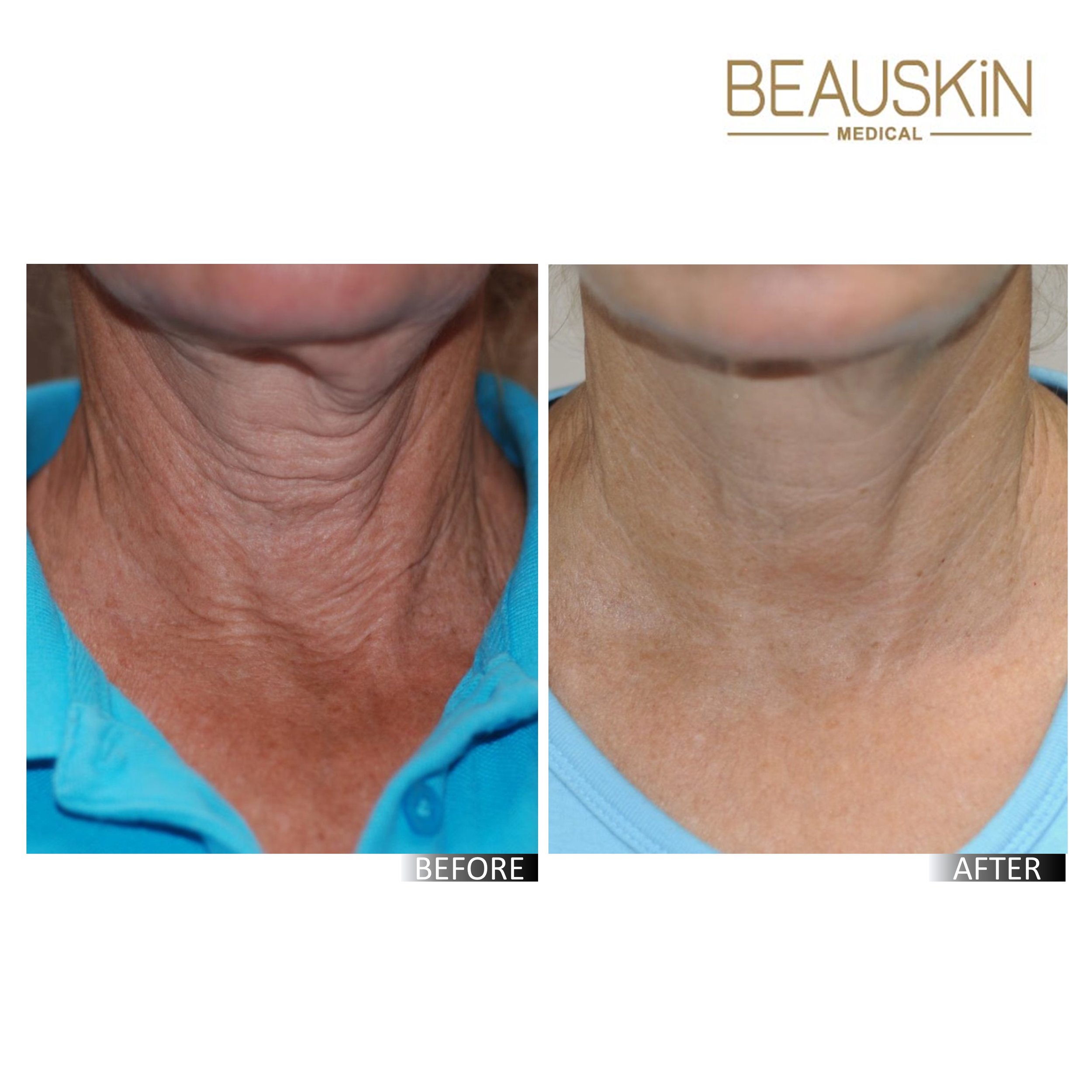 Exilis 360 B&A2.jpg