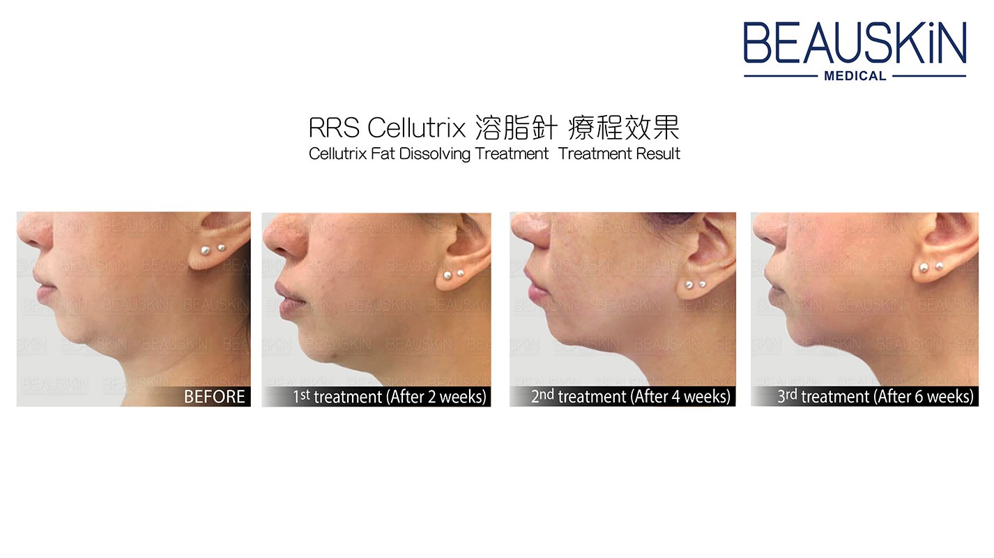 BEAUSKIN Medical CELLUTRIX 溶脂針