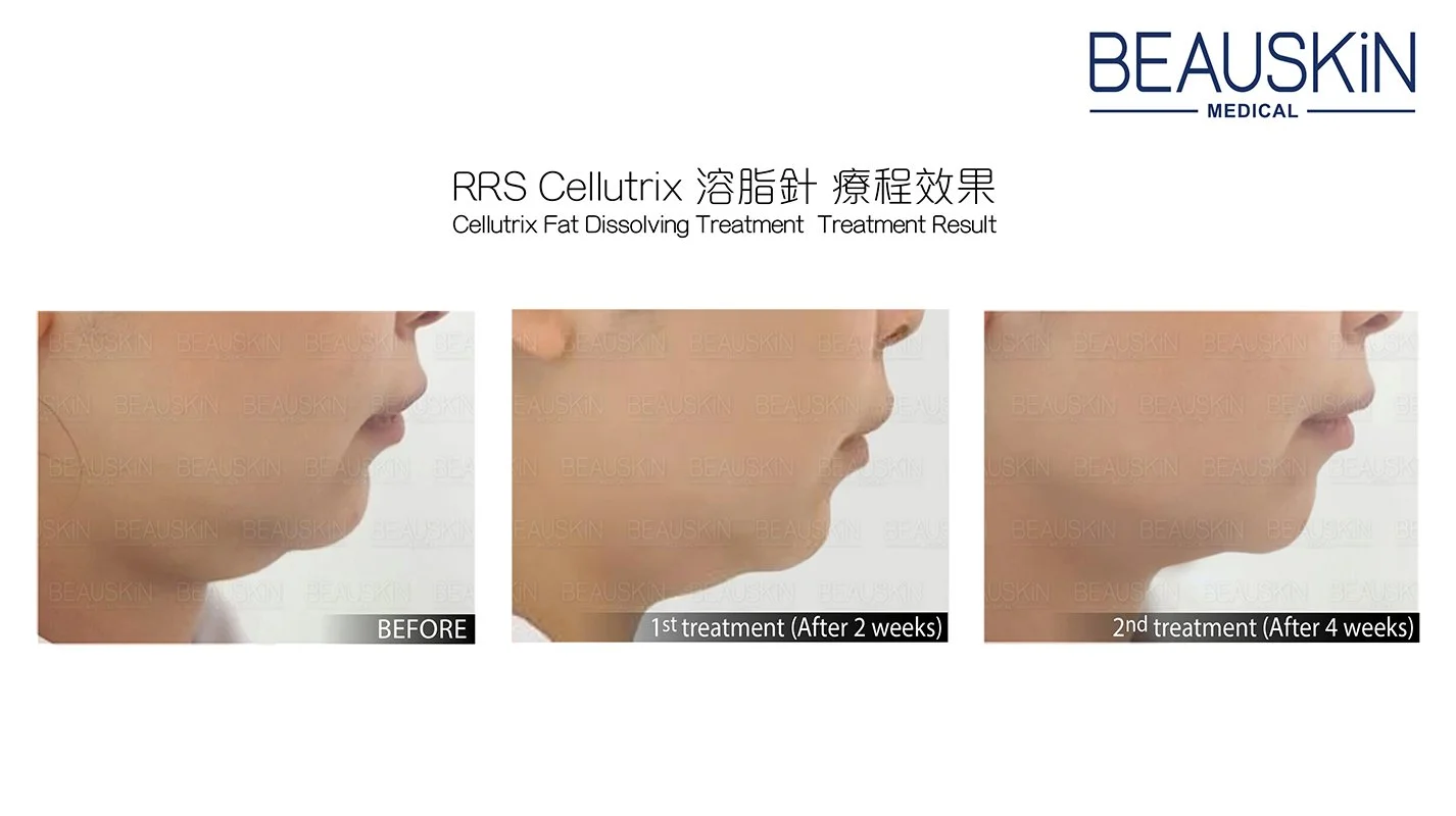 BEAUSKIN Medical CELLUTRIX 溶脂針