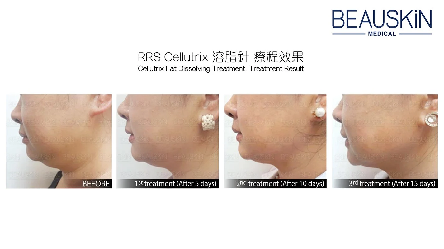 BEAUSKIN Medical CELLUTRIX 溶脂針