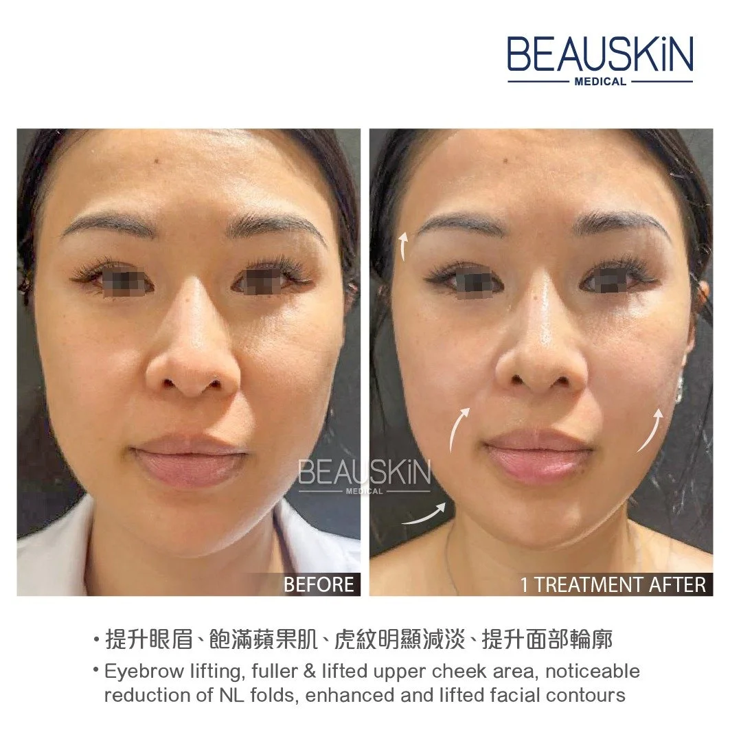 Emface 前後對比照 - BEAUSKIN Medical