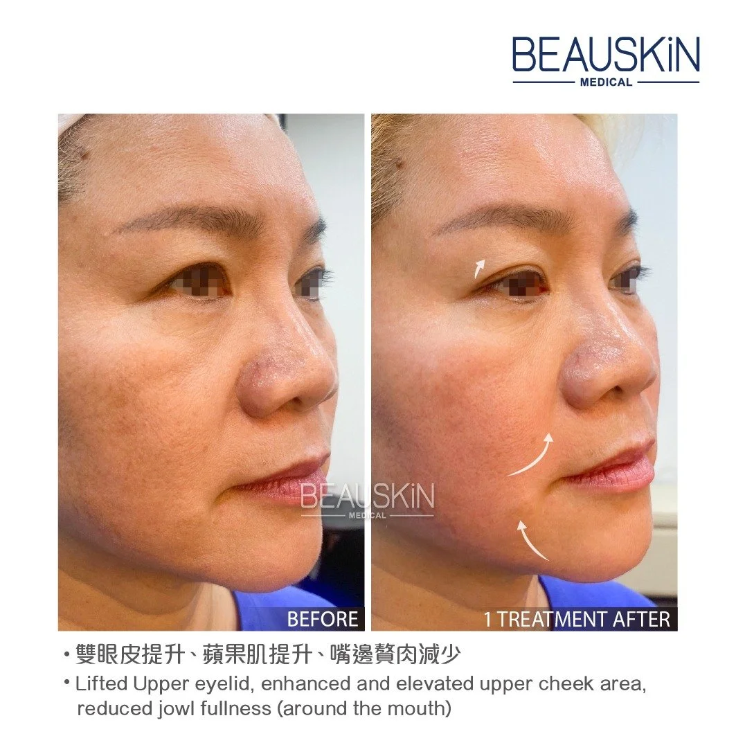 Emface 前後對比照 - BEAUSKIN Medical