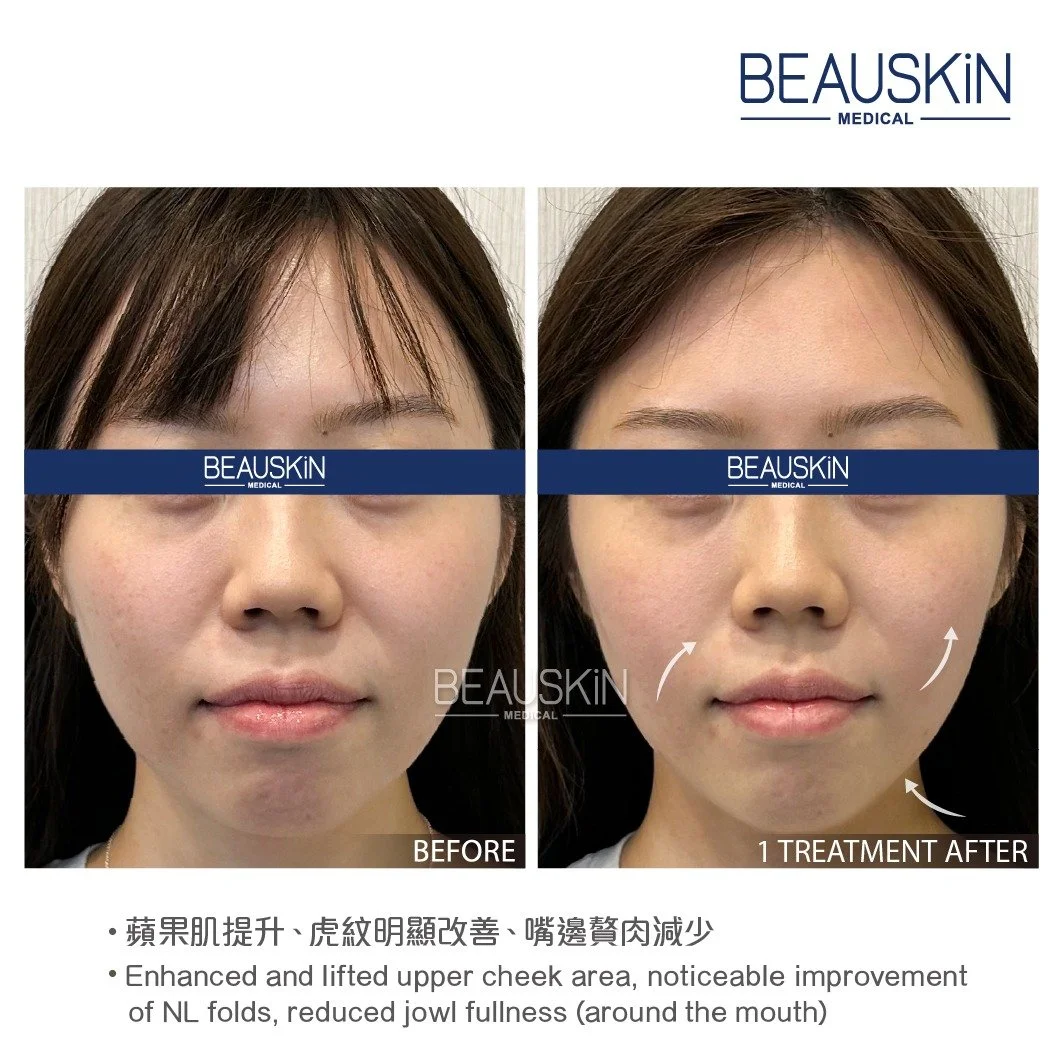 Emface 前後對比照 - BEAUSKIN Medical