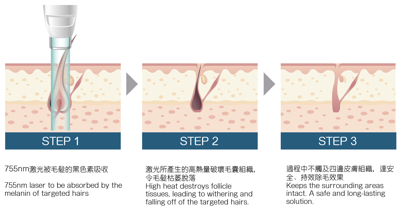 Gentlelase 755nm 激光脫毛原理