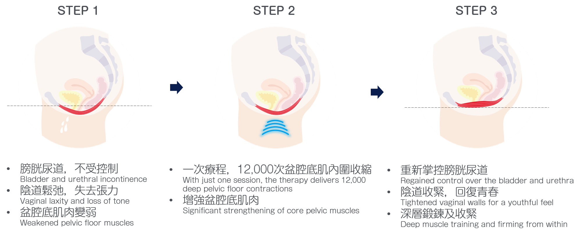 Emsella 功效 - BEAUSKIN Medical