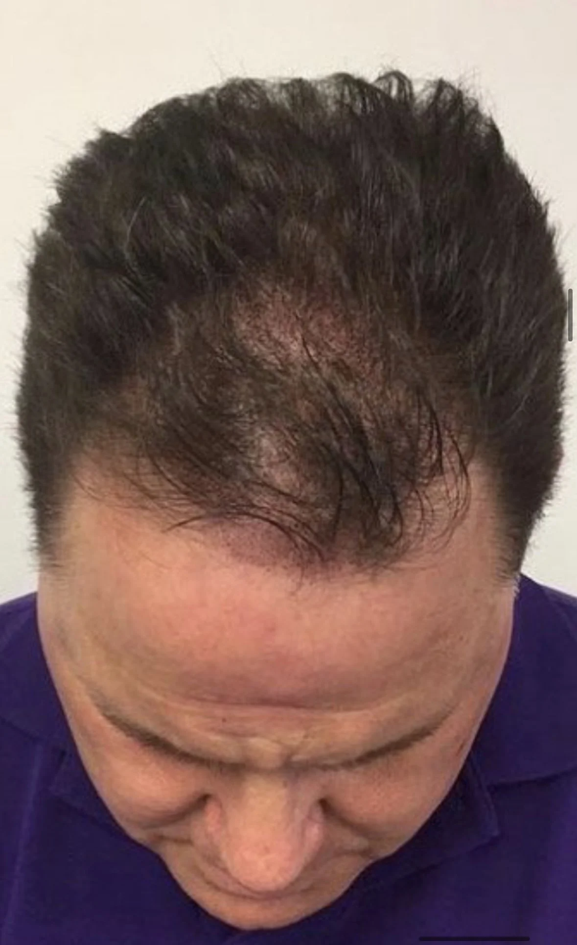 EXAMPLE 2 AFTER: Single treatment results