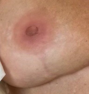 EXAMPLE 3 AFTER: Photo taken same day as first treatment with Flat-To-3D effect.