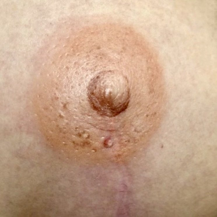 EXAMPLE 2: Following a single mastectomy which resulted in a completely flat nipple, patient requested nipple matching to opposite breast.