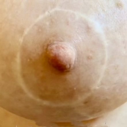 EXAMPLE 1 BEFORE: Patient presented with loss of pigmentation & necrosis following multiple breast surgeries.