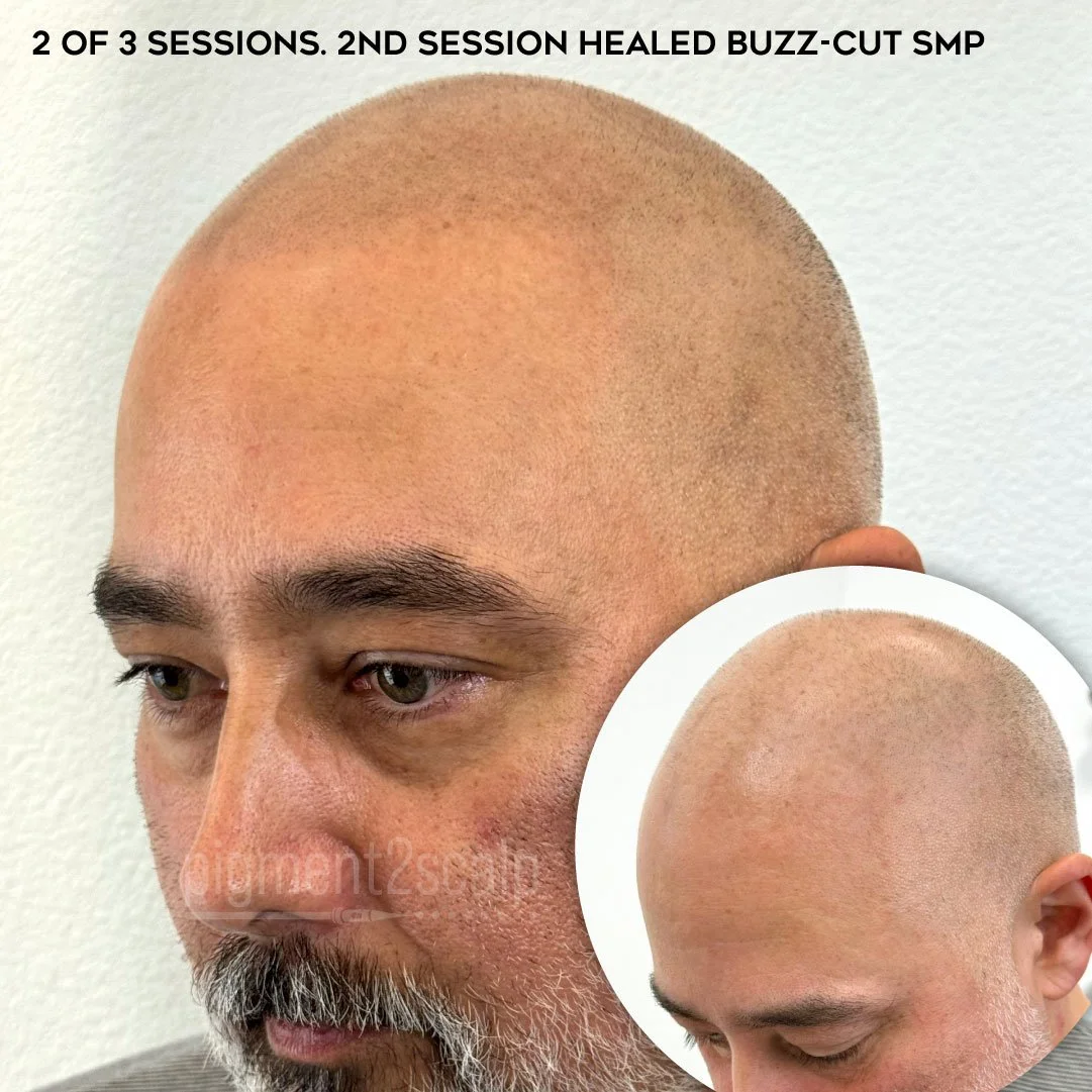 scalp micropigmentation with gray grey hair mens hair loss solution
