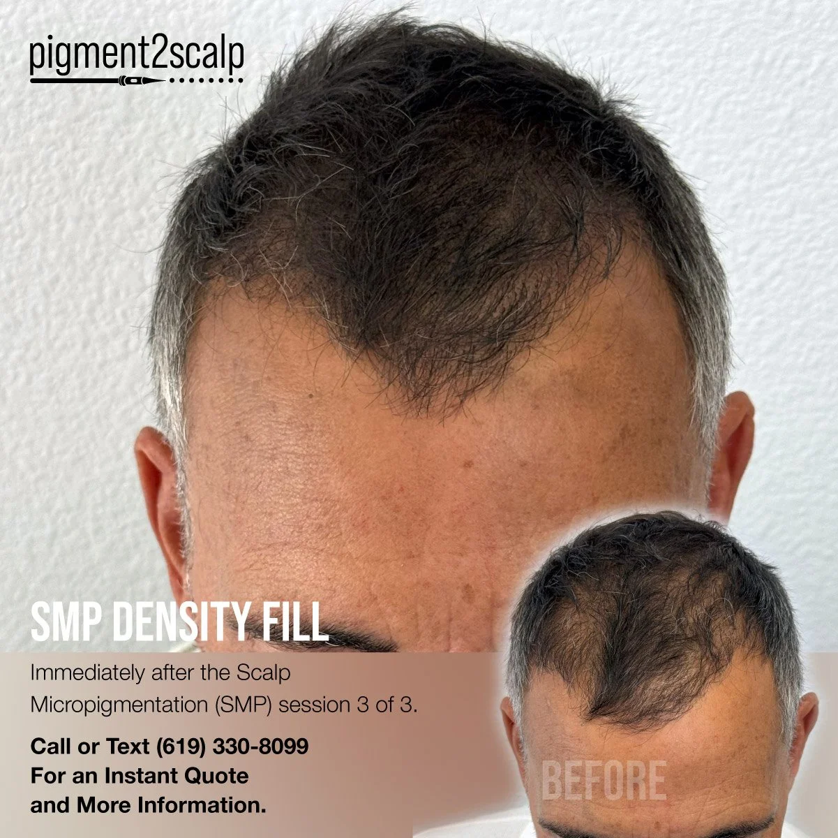 scalp micropigmentation smp san diego density fill for a fuller look