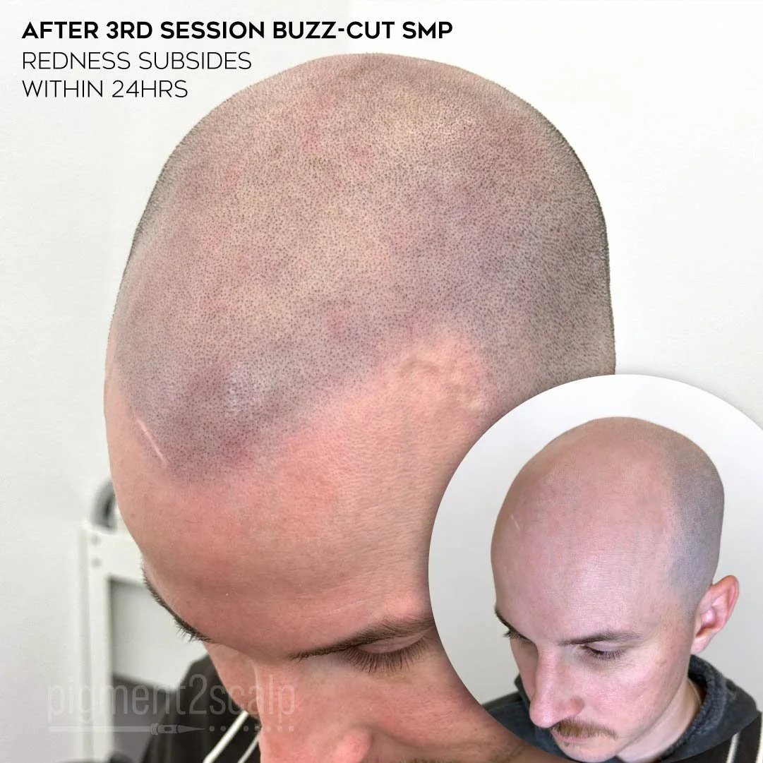 smp-san-diego-scalp-micropigmentation-healed-72dp-05_hair-loss.jpg