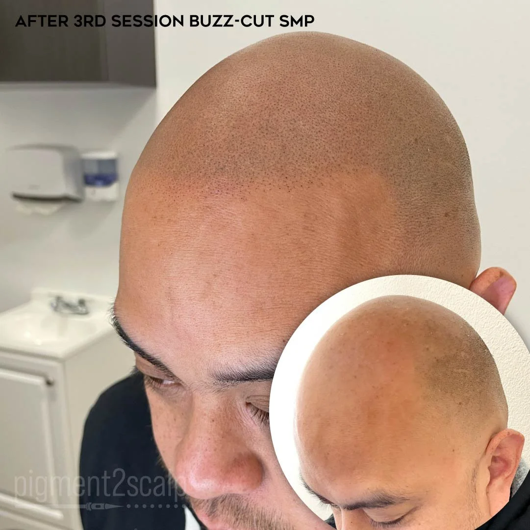 smp-san-diego-scalp-micropigmentation-healed-72dp-09_buzz-cut-smp.jpg