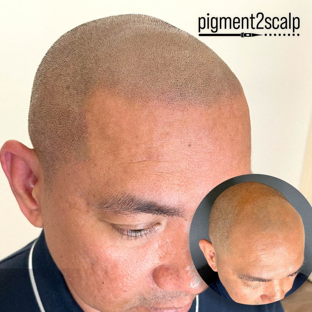 Get a clean and even look across your whole scalp. Get your Free Quote today!
