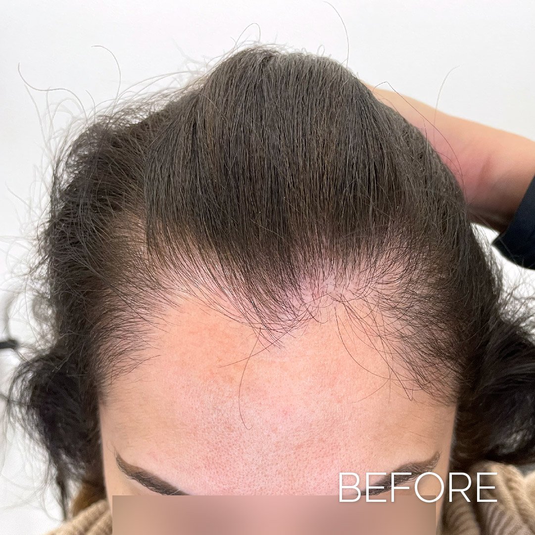 san-diego-thinning-hair-density-smp-front-results-C-02.jpg