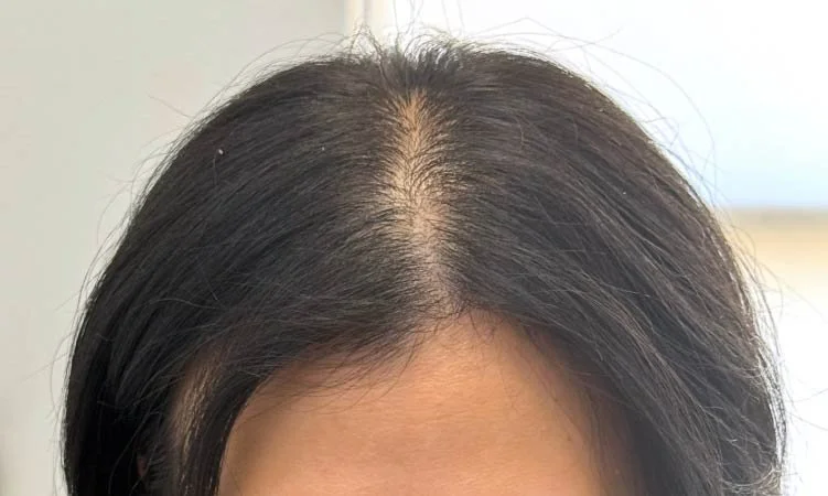 Scalp Micropigmentation for Women with a Widening Part Line