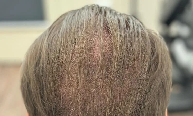 How Scalp Micropigmentation Looks With Existing Hair (SMP Density Fill)