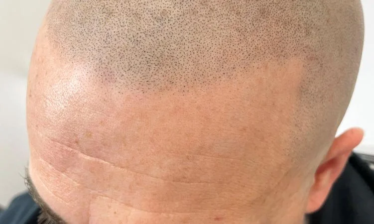 How Long Does Scalp Micropigmentation Last?
