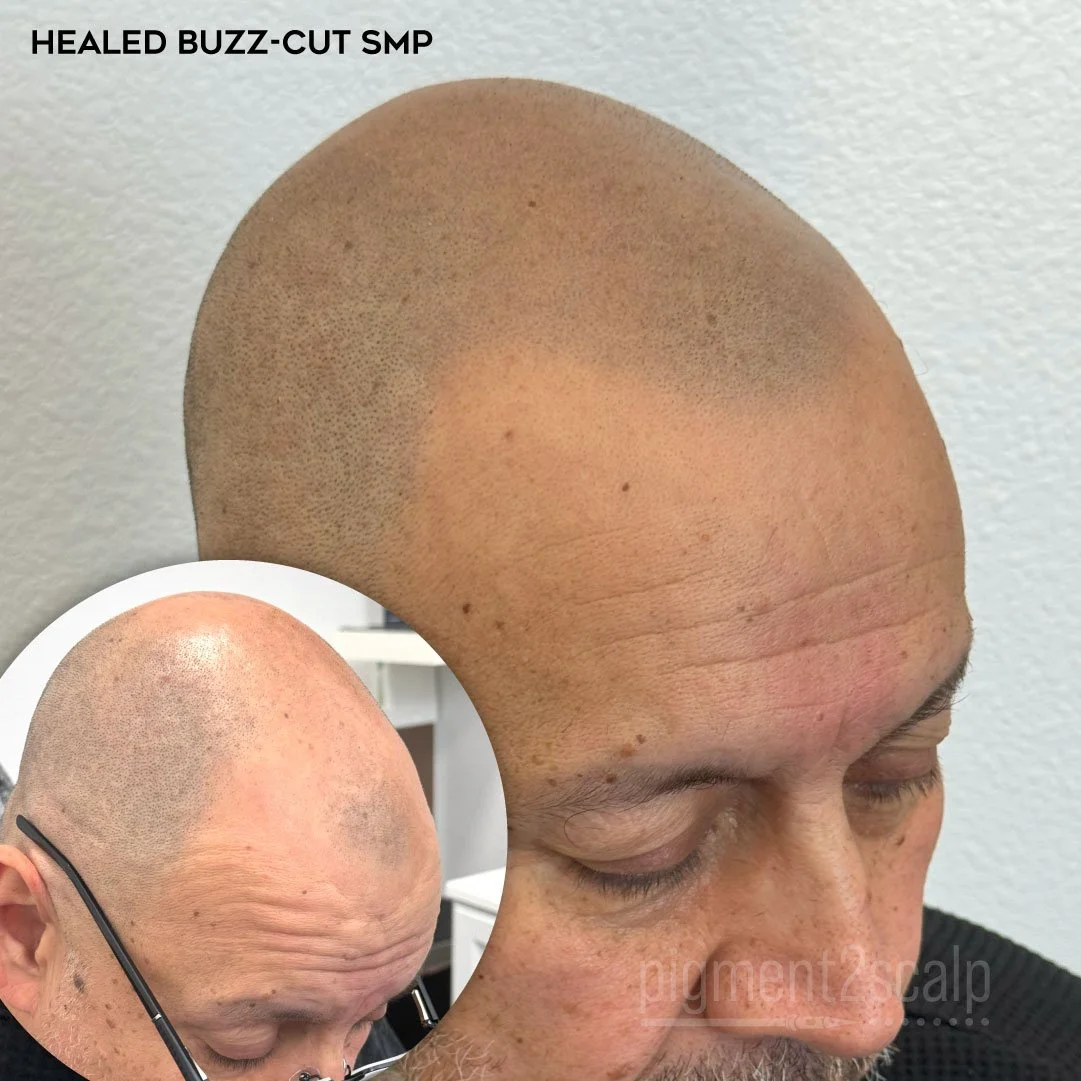 smp-shair-loss-scalp-micropigmentation-healed-24.jpg