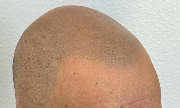 What Does Healed Buzz Cut Scalp Micropigmentation Really Look Like?