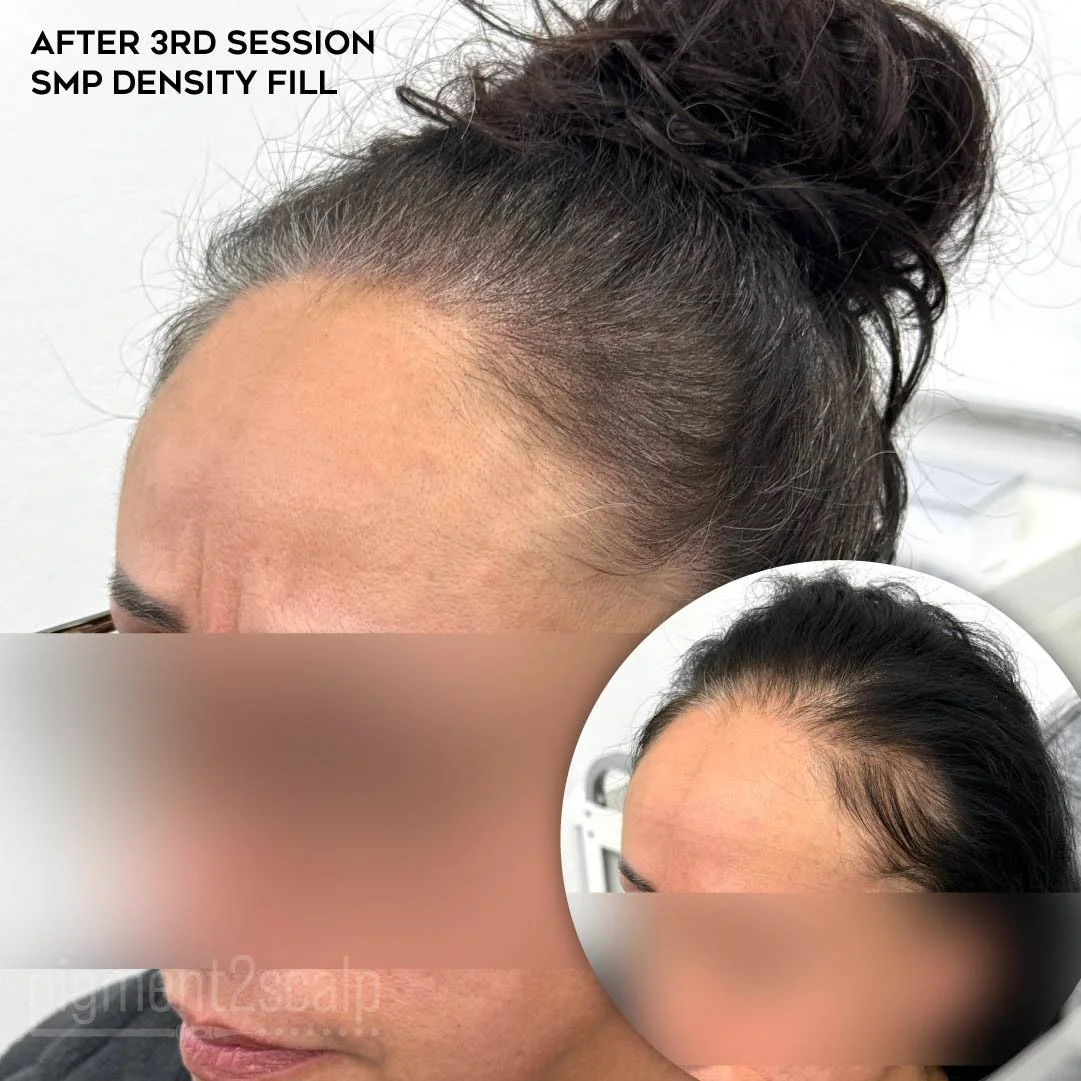 smp-san-diego-scalp-micropigmentation-healed-72dp-14_thinning-hair.jpg