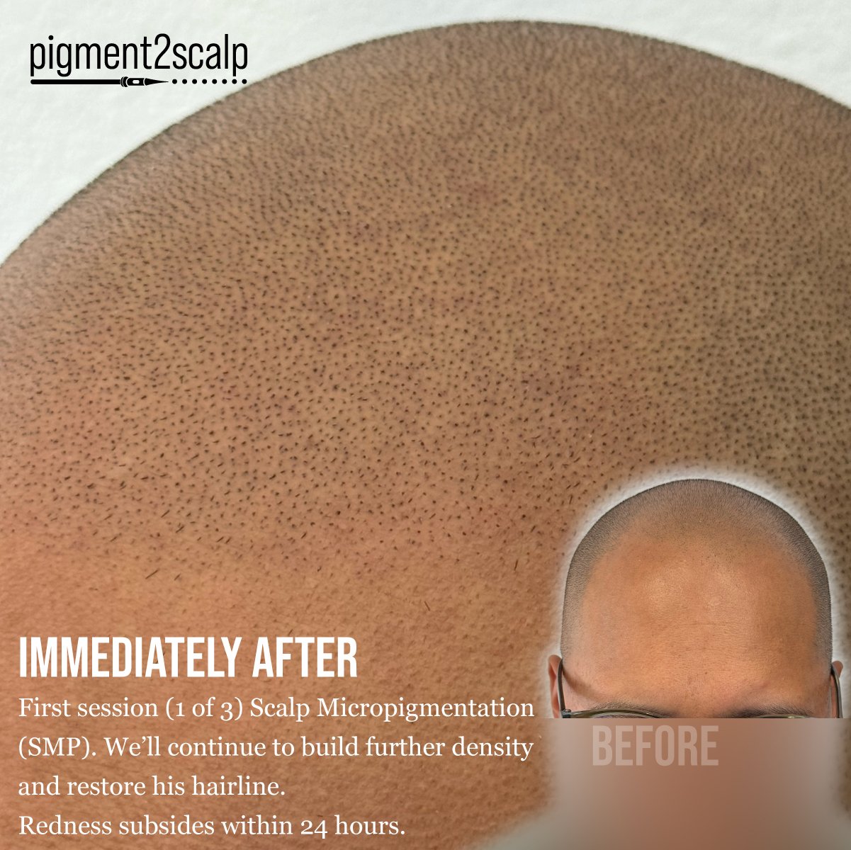 Close up smp scalp micropigmentation buzz