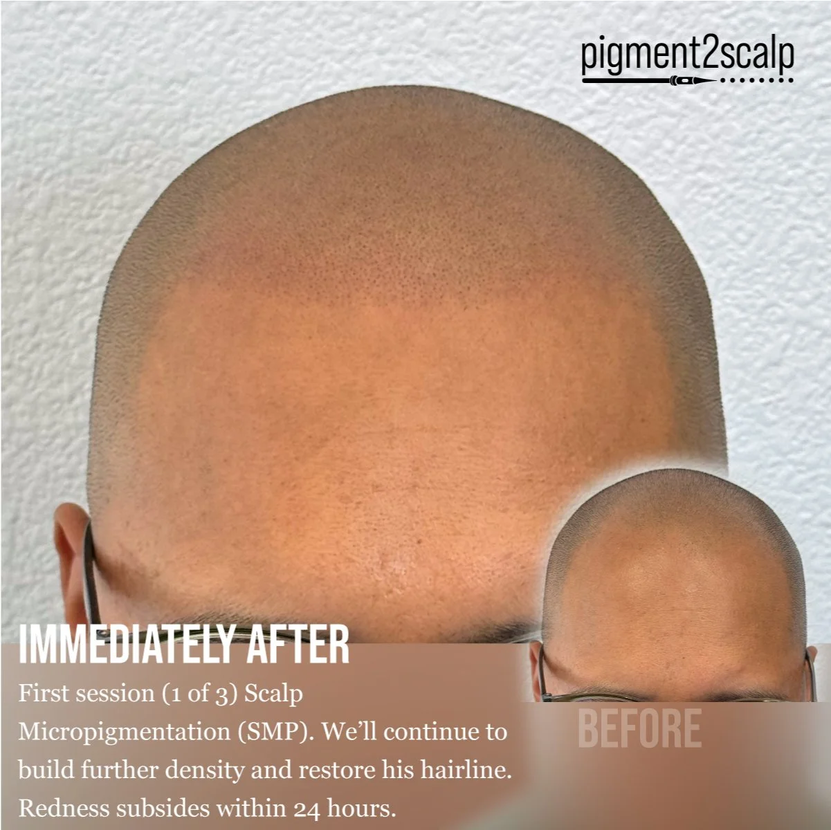 After First SMP Session scalp micropigmentation, restore hairline