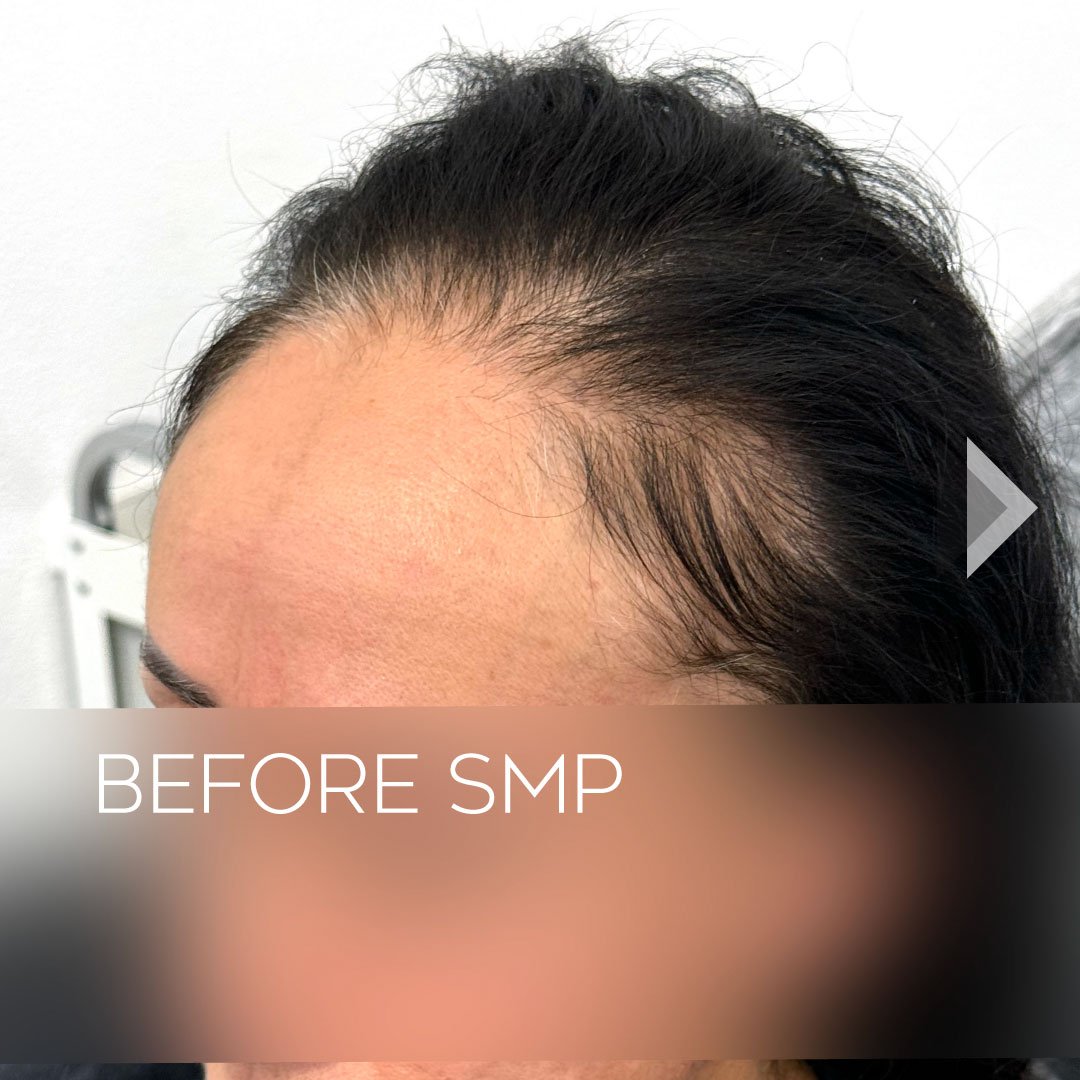 Female_smp-Density_Fill_Thinning_Hair_san-diego02.jpg