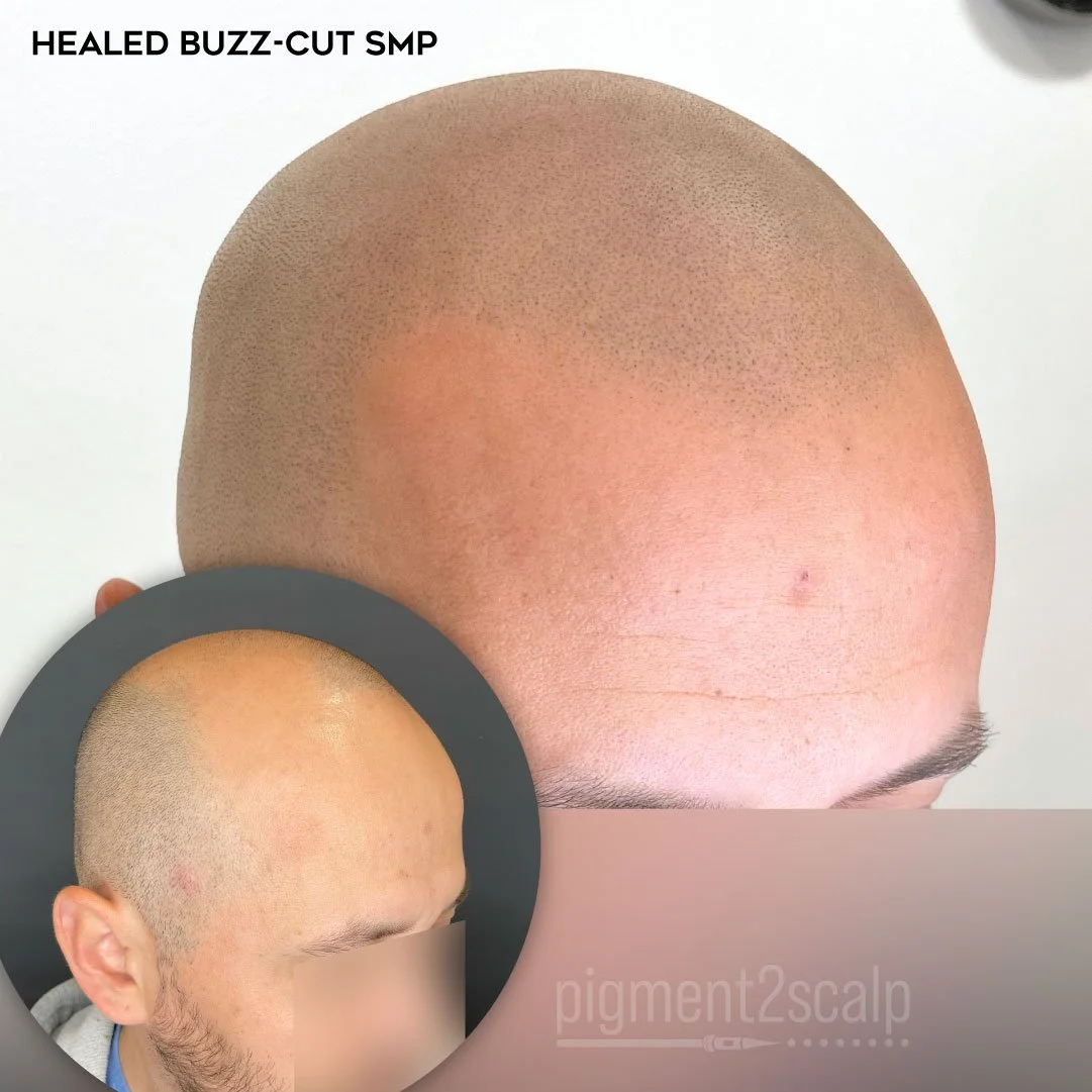 natural looking healed scalp micropigmentation smp results