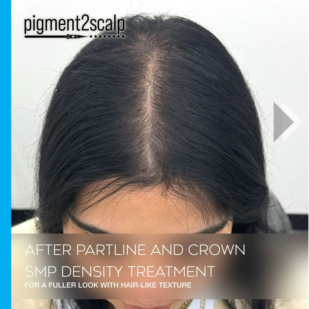 Female_smp-Density_Fill_Thinning_Hair_san-diego-01.jpg