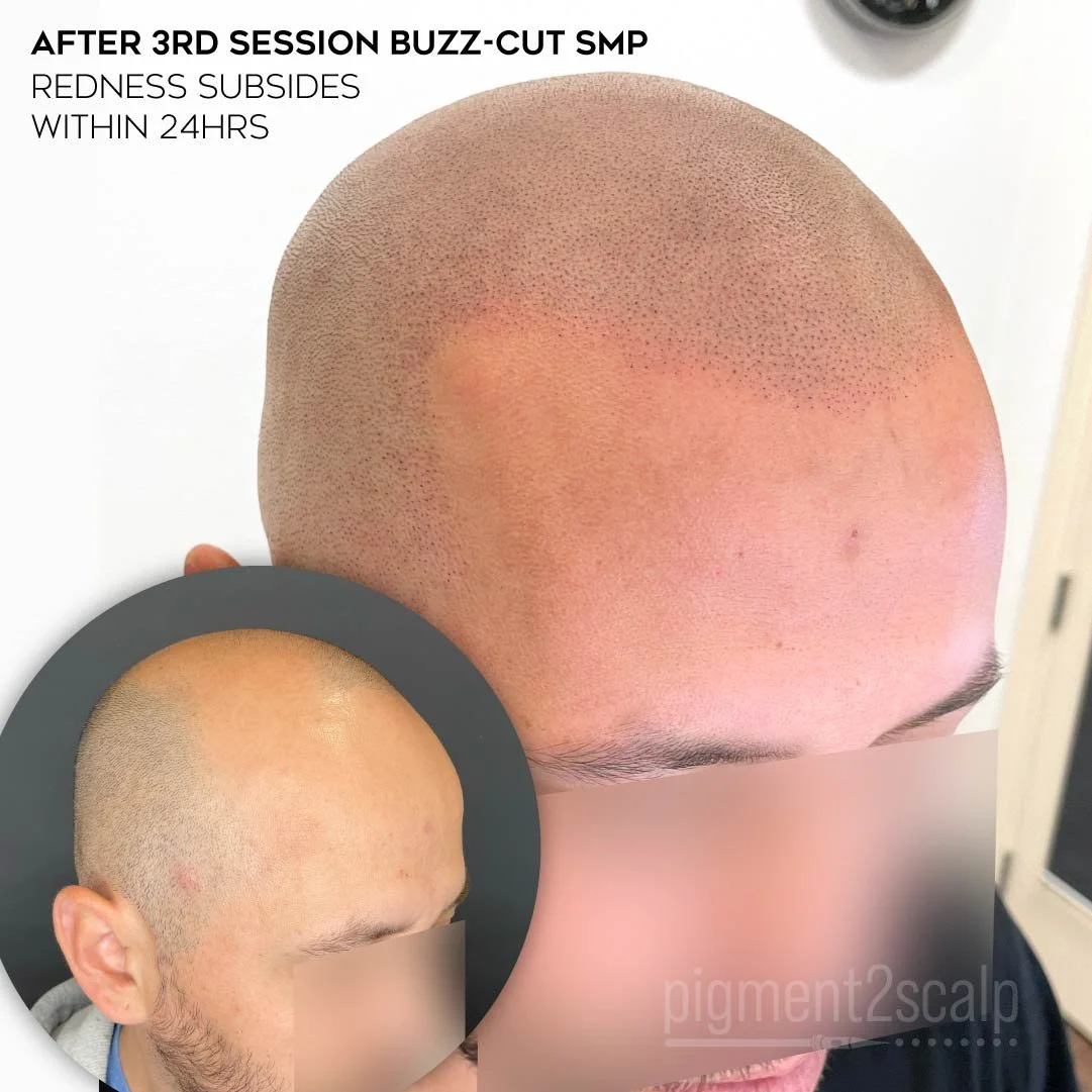 smp-san-diego-scalp-micropigmentation-healed-72dp-13_best-smp-artist.jpg
