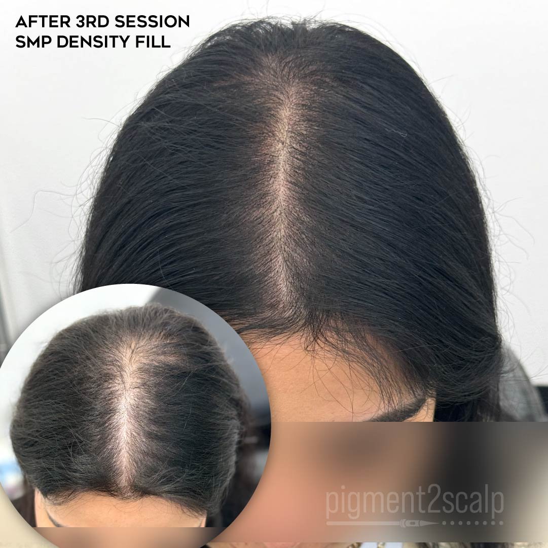 smp-san-diego-scalp-micropigmentation-healed-72dp-07_Female-hair-loss.jpg