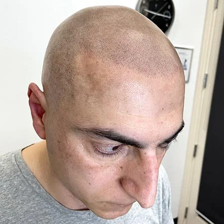 Man with male patter balding and alopecia with scalp micropigmentation smp as a hair loss solution